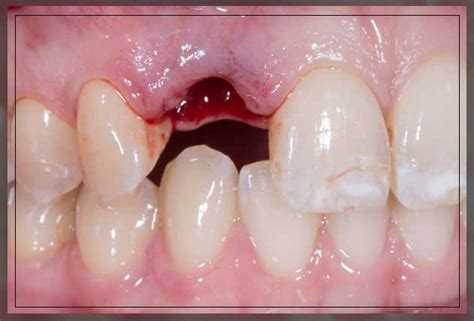 Avulsed Tooth: Symptoms and Treatment - Dentist Ahmed