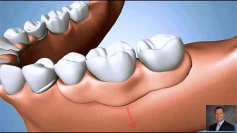 Partial Denture Problems | Implant Dentist Pasadena TX - YouTube