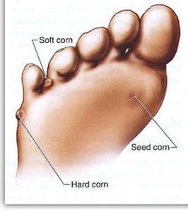 Corns & Callus Treatment - Custom Foot Clinic & Orthotic Centre