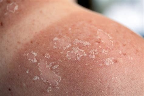 Pictures Of Skin Cancer On Back - the meta pictures