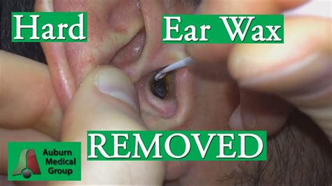 Hard Ear Wax (Cerumen) Removal with a Curette | Auburn Medical Group ...