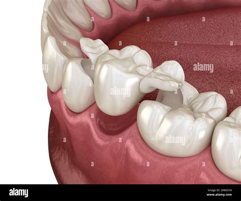 Maryland bridge made from ceramic, premolar tooth recovery. Medically ...