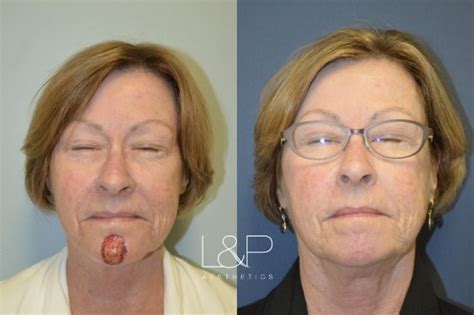 Reconstructive Surgery on the Chin, Case 44 | L&P Aesthetics