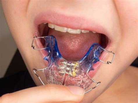 Crossbite Treatment Options | WNY Orthodontists | Free Consultations