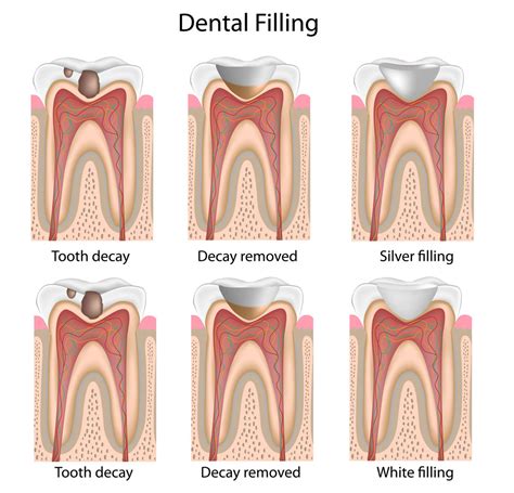 Dental Caries (Cavities) Comprehensive Review - Frisco Kid’s Dentistry