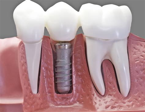 Are Dental Implants Permanent? - American Society of Implant and Reconstructive Dentistry