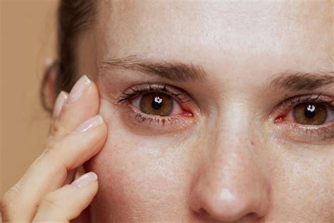 Eye Allergies: Most Common Reasons For Itchy Red Eyes | Allergy ...