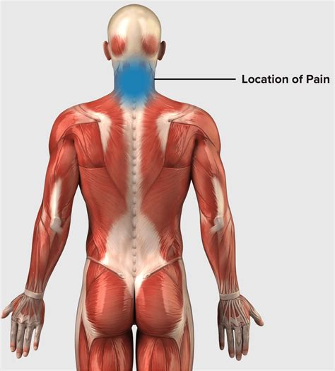 Neck Strain Protocol for Rock Climbers