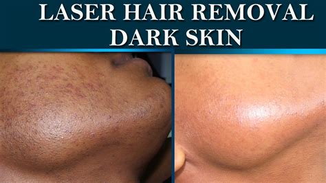 Laser hair removal at Dermalogics. Before & After on dark skin. - YouTube