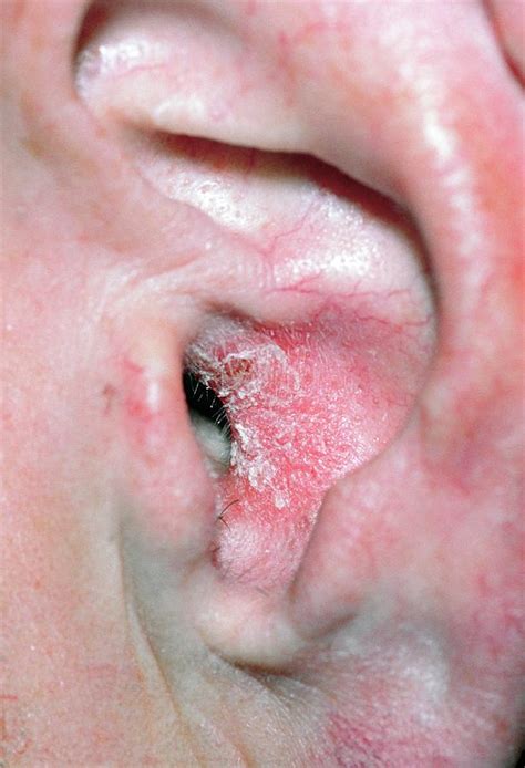 Eczema In The Ear Canal. Photograph by Dr P. Marazzi/science Photo Library