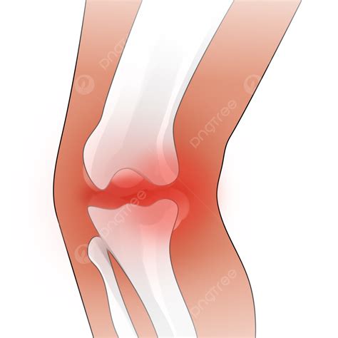 Fracture PNG Image, Arthritic Leg Fracture, Arthritis, Legs, Fracture PNG Image For Free Download