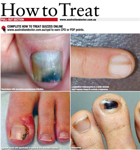 Ten Important Nail Disorders - Sinclair Dermatology