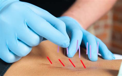 Dry Needling - Benphysio Sdn Bhd Kuala Lumpur (KL), Malaysia, Selangor, Damansara, Bangsar, Puchong