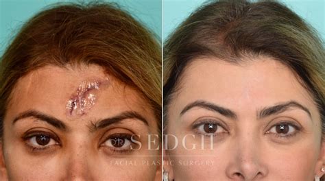 Scar Revision Before & After Photos | Dr. Sedgh