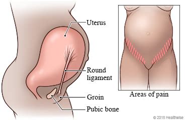 ROUND LIGAMENT PAIN IN PREGNANCY - Health2u