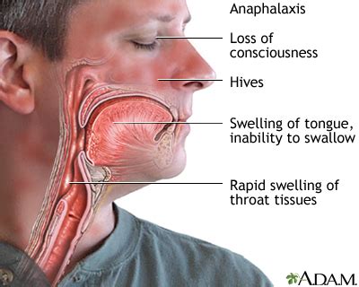 Anaphylaxis Swelling