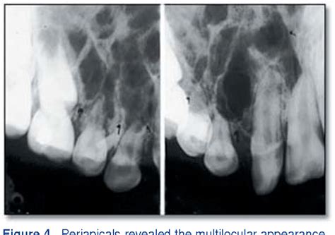 Figure 4 from Odontogenic myxoma--a case report and clinico-radiographic study of seven tumors ...