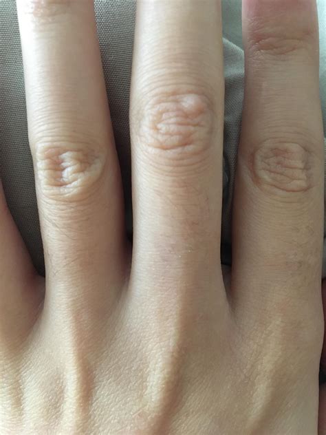 What is this bump on my finger? Could it be autoimmune related? : r ...