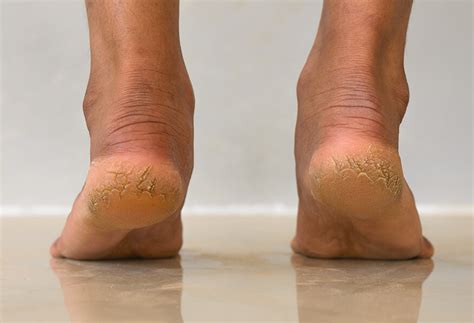 Dry feet (cracked heels) — Medical Secrets