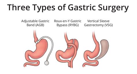 8 Gastric Surgery Types to Choose - Weight Loss Surgery