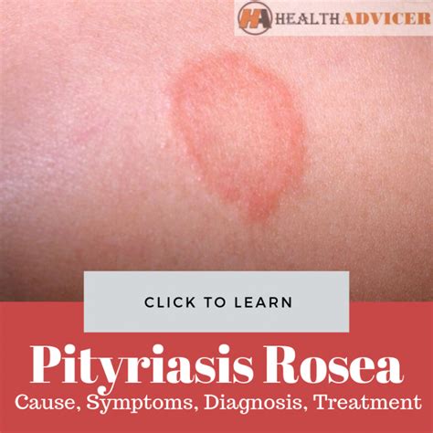 Pityriasis Rosea Skin