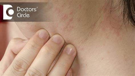 Different skin rashes that itch - zebradon