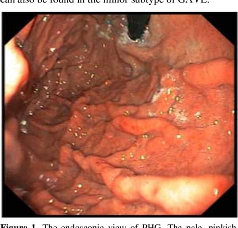 Figure 1 from Comparison of portal hypertensive gastropathy and gastric antral vascular ectasia ...