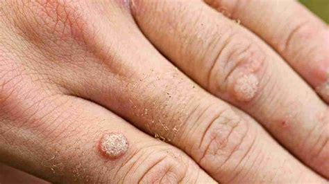 Skin Cancer Or Benign Wart? How To Identify Cancerous Warts