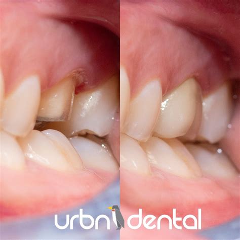 Common Tooth Decay Symptoms | Tooth Decay Treatment in Houston, TX