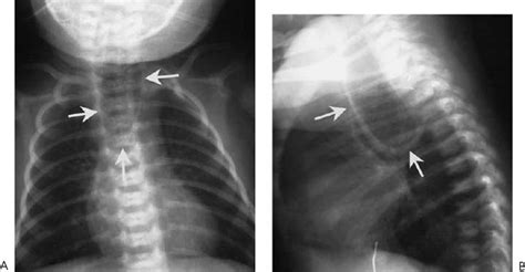 Tracheoesophageal Fistula and Esophageal Atresia | Radiology Key