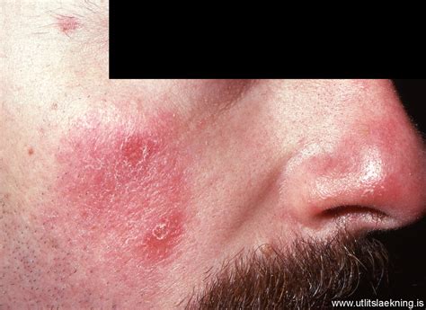 Lupus Skin Lesions Images