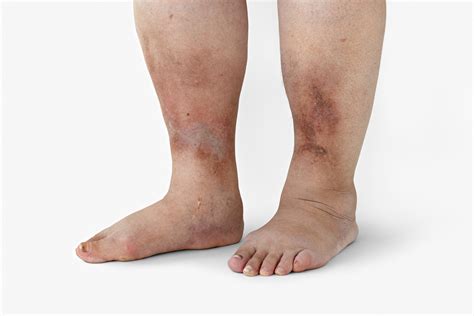 Diabetes Symptoms Feet Swelling