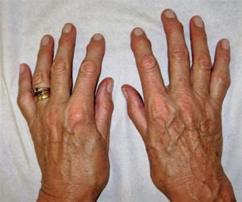 List 104+ Images Photos Of Osteoarthritis In Hands Sharp