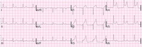 Dr. Smith's ECG Blog: Transient STEMI, no T-wave Evolution and no Wall ...