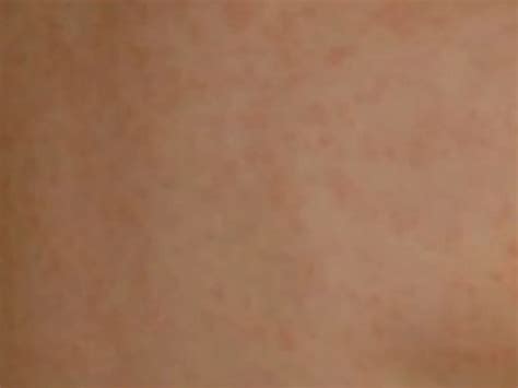 Amoxicillin Rash – Symptoms, Treatment, Pictures | HubPages