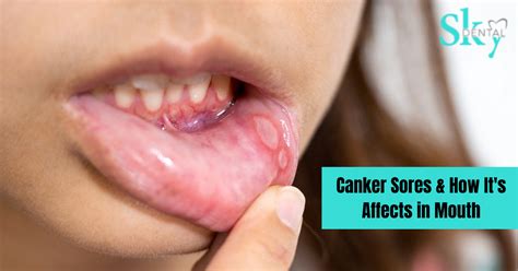 Canker Sores & It's Affects in Mouth - SKY Dental Vijayawada
