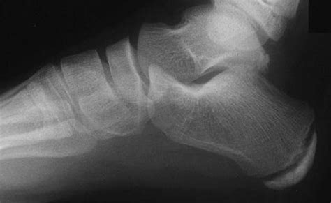 Severs Disease (Calcaneal Apophysitis) - Ankle, Foot and Orthotic Centre