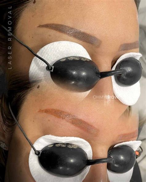 Laser Eyebrow Tattoo Removal Before and After Cases