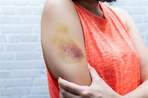 How Do You Know When a Bruise is Serious? | State Urgent Care
