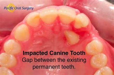 Untreated Impacted Canine Tooth in Ventura, CA - Pacific Oral Surgery