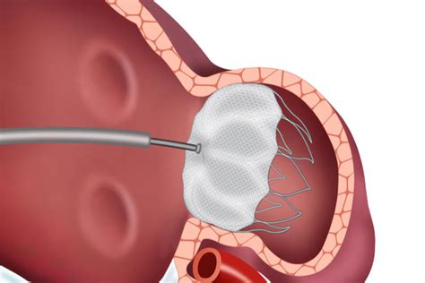 Improving Heart Patients’ Lives with Left Atrial Appendage (LAA) Closure Devices