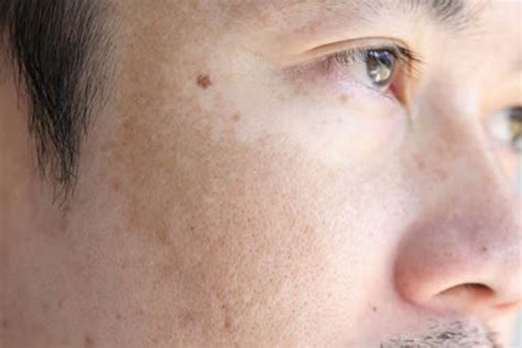 close up of sun damaged skin - Bakersfield Dermatology - Advanced ...