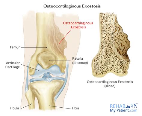 Osteocartilaginous Exostosis | Rehab My Patient