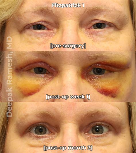 Recovery from Eyelid Surgery New Jersey | Dr. Deepak Ramesh