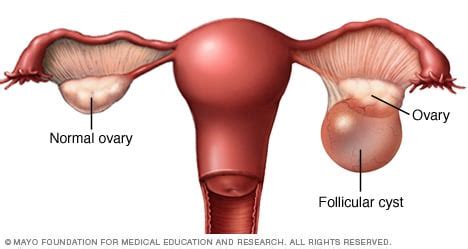 Ovarian Cyst