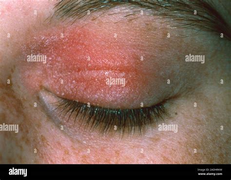 Allergic reaction to eye cosmetic. A red rash on the eyelids of a ...