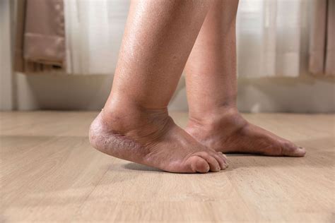 Leg Edema: Causes, Treatment & Its Impact on Wound Care