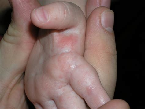 Dyshidrosis of hands and feet: causes, symptoms, treatment. Ointments, baths and folk remedies ...