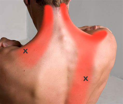 Trapezius Trigger Point Pain