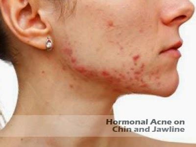 Hormonal Acne on Chin and Jawline - Cause and Treatment | Hormonal Acne ...